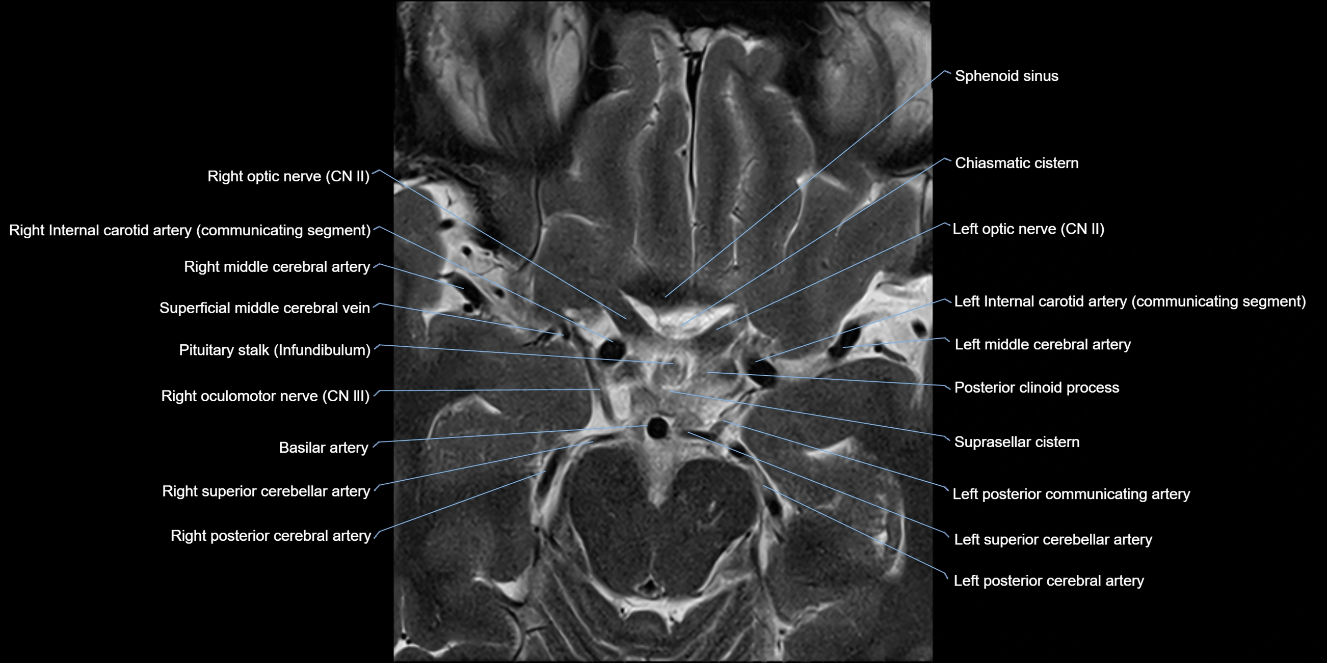 MRI cavernous sinus axial cross sectional 3T anatomy image-img-11001-00015.webp